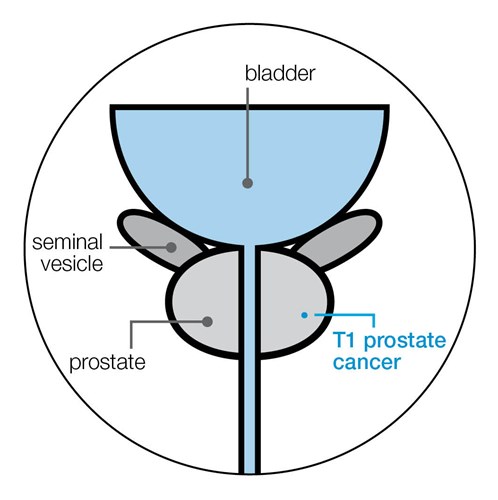 t1-stage-prostate-cancer